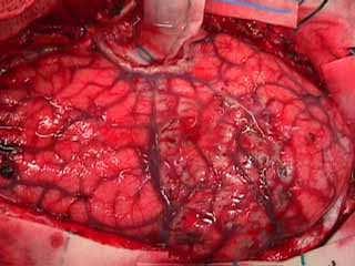 5 years) 46% Engel class I All patients experienced transient hemiparesis Resolved within 6