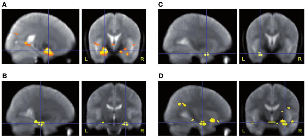 Imaging memory in temporal lobe epilepsy Brain 2010: 133; 1186 1199 1191 Table 1 fmri activation peaks in the hippocampus for the main effects of encoding words and faces Subjects fmri contrast