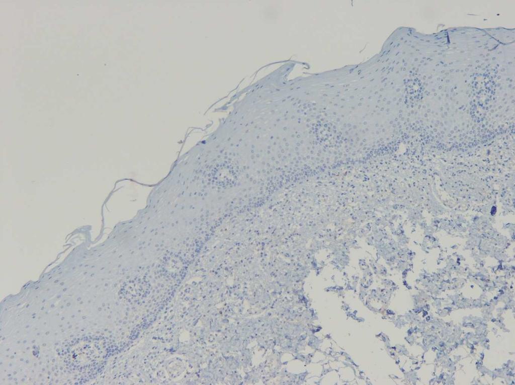 Nafarzadeh Sh et al. Fig 1. IHC staining of normal oral mucosa showing no expression of SMAD3 (X100).
