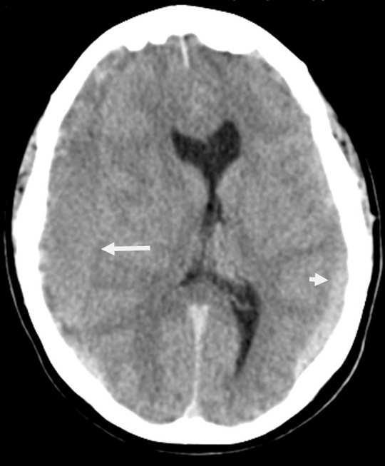 Figure 1 - Brain CT scan showed bilateral subdural hematomas more extensive at the right