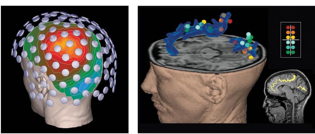 Magnetoencephalography (MEG) An alternative way to record the rhythms of the cerebral cortex is via MEG.