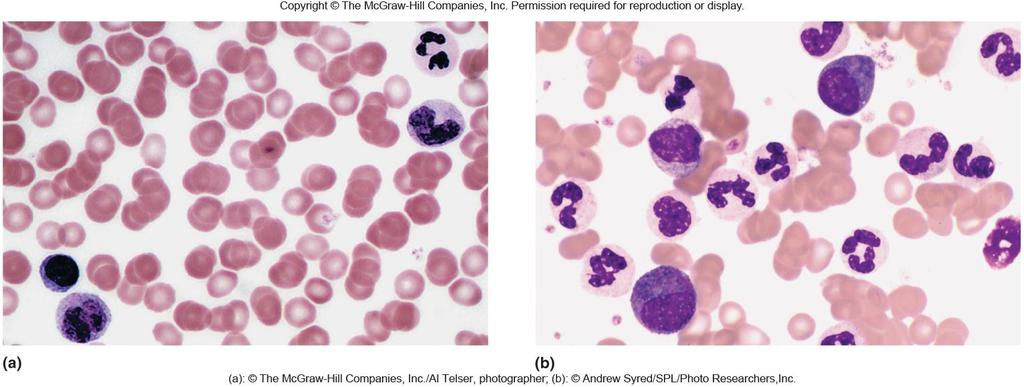 Normal versus leukemia (granulocytic