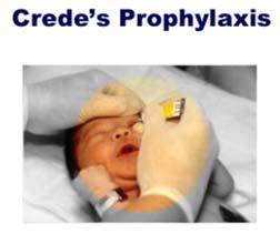 History of Eye Prophylaxis 1881 Neonatal eye prophylaxis introduced to treat gonococcal ophthalmia as there was no effective treatment for