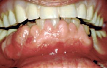 Gingiva swelling due to