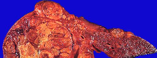 Liver cirrhosis of any cause Chronic C o c hepatitis epat t s B Risk increases with Male gender Age Diabetes