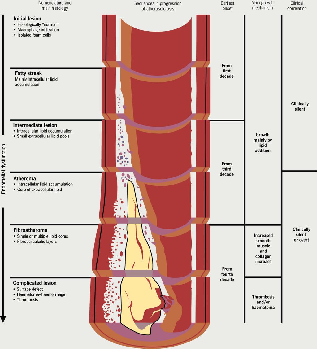 What causes CVD? The Atherosclerosis process Atherosclerosis causes arteries to narrow, weaken and be less flexible.