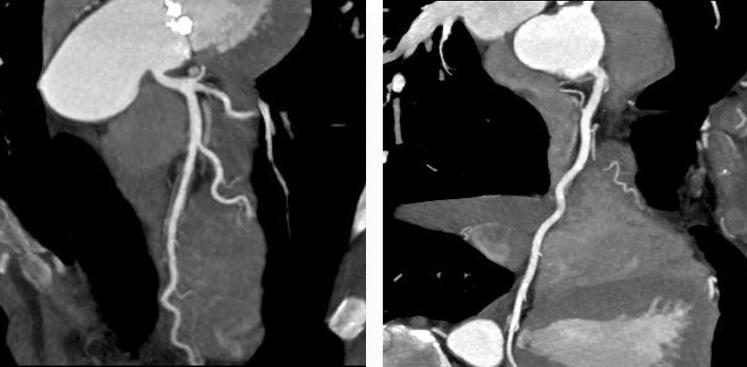 Figure 3 Computed tomography coronary angiography (CTCA) and coronary angiography (CCA) in a 58-yearold man with atypical chest pain.