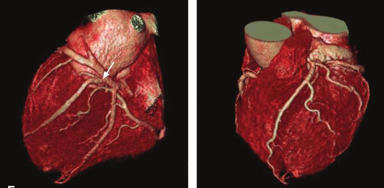 Volume-rendered image (C) shows a right dominant supply with the posterior descending artery arising from the distal RCA (arrow).