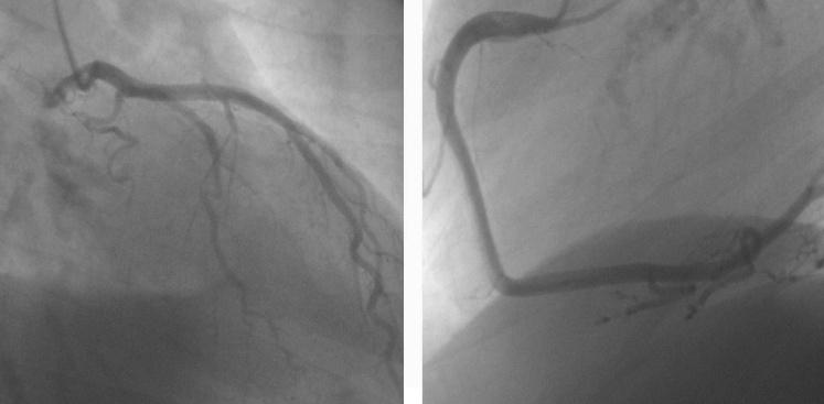 CCA of the LAD (E) and the RCA (F) confirms smooth vessel contours without stenosis.