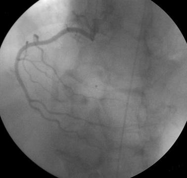 Figure 4 Computed tomography coronary angiography (CTCA) and coronary angiography (CCA) in a 51-year-old man with atypical chest pain.