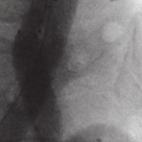 A small type 2 endoleak from a pair of lumbar arteries was seen.