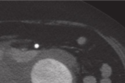 Figure 2: Intraoperative aortogram at the initial procedure