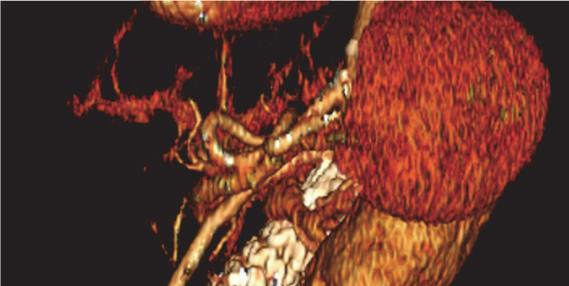 from the large aneurysm sac and the