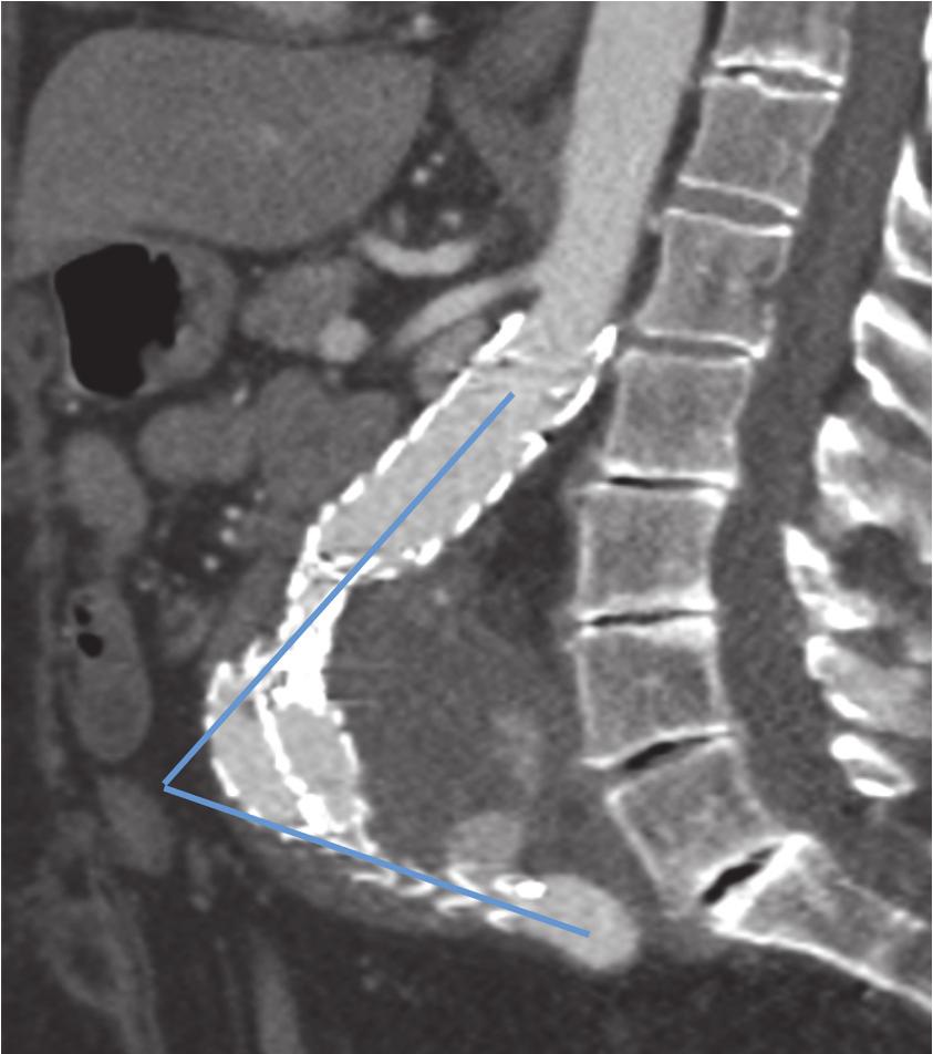 4 Case Reports in Vascular Medicine Figure 7: Sagittal view of computed tomography performed at 1, 6, and 12 months of follow-up demonstrating the anterior displacement of the aortic endograft.