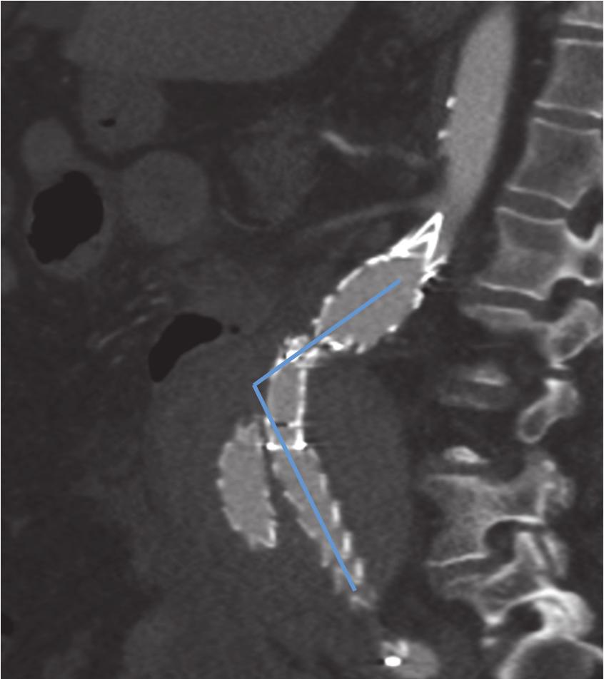 Migrations of the iliac limb extensions have been well described in the current literature [10]. In a prospective twocenter analysis by Bisdas et al.