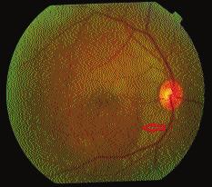 Introduction Central serous chorioretinopathy (CSCR) is the serous detachment of the neurosensory retina (Figure-1). CSCR is one of the 10 most common conditions that affect the macula.