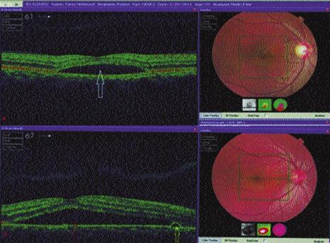 Features of central serous chorioretinopathy presenting at a tertiary care hospital in Lahore 480 Figure-3: Optical coherence tomography. a) Optical coherence tomographic image of CSCR in right eye.