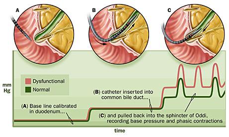 Manometry of the sphincter of Oddi requires a sophisticated system by which the motility pattern of the sphincter is recorded.