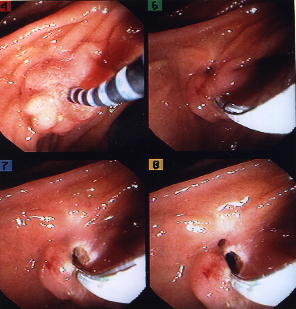 Does the addition of a pancreatic sphincterotomy to