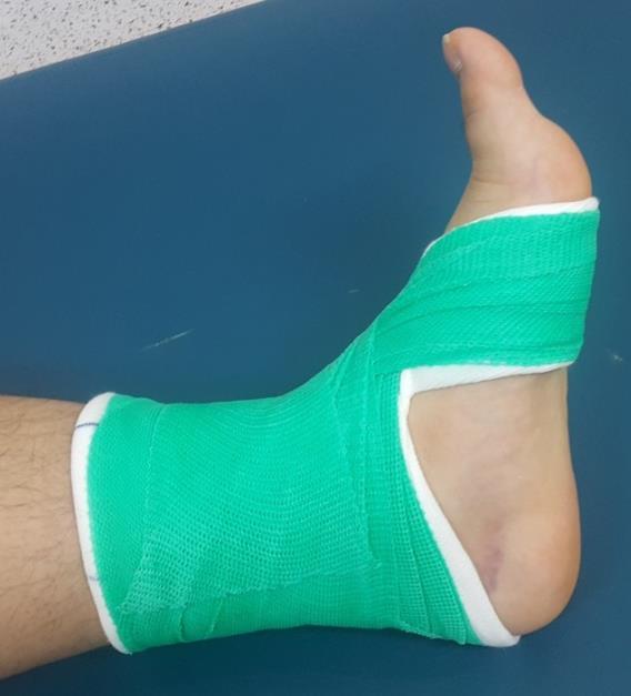Technique K-type Indication Pilon fracture, Lateral malleolar fracture, Posterior malleolar fracture Calf