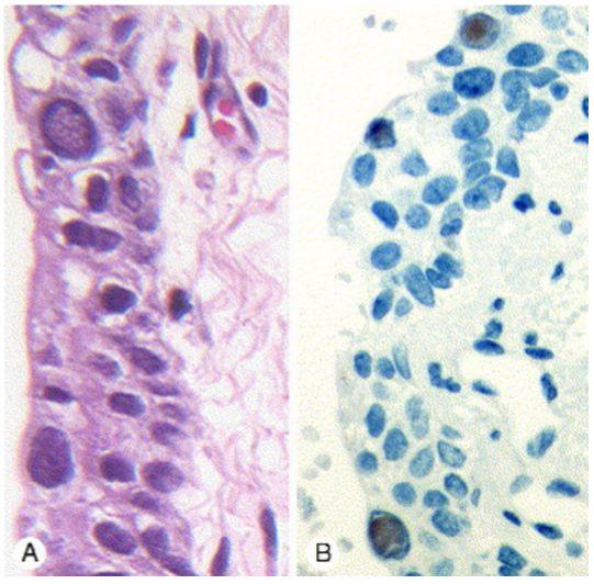 Pathology A, Transitional epithelium with scattered cells showing PV cytopathic effect (basophilic intranuclear inclusions).