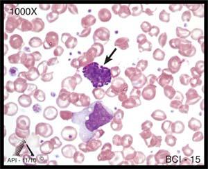 EDUCATIONAL COMMENTARY MORPHOLOGIC CHANGES IN PERIPHERAL BLOOD CELLS Educational commentary is provided through our affiliation with the American Society for Clinical Pathology (ASCP).