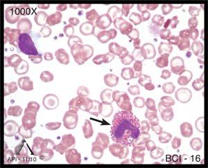 Image BCI-16 is an eosinophil. Just as basophils are readily distinguished by the very dark specific granules, eosinophils feature red-orange granules that fill the cytoplasm.