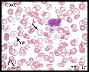 The cells identified in Image BCI-17 are codocytes, or target cells. Note the central, dense area of hemoglobin surrounded by a white rim and then a final area of more hemoglobin.