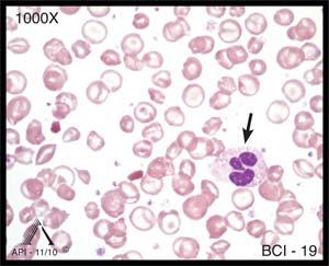 Image BCI-18 is a nice example of a small, normal lymphocyte. Lymphocytes vary in size.
