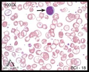 This comparison is a useful guide in determining the size of erythrocytes and in this case indicates microcytosis. Image BCI-19 shows a normal segmented neutrophil.