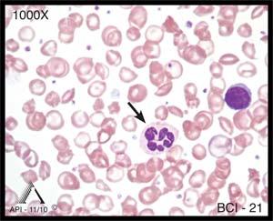 Although the diagnosis for this patient is thalassemia trait (or beta thalassemia minor), it is likely the patient also has another abnormal hemoglobin disorder called hemoglobin C disease.