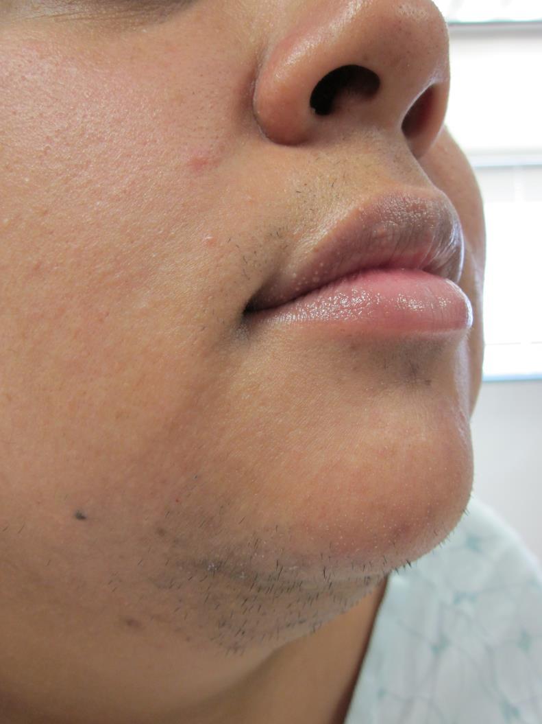 Hirsutism affects 53% of patients with PCOS 31% in high-risk population Important systemic