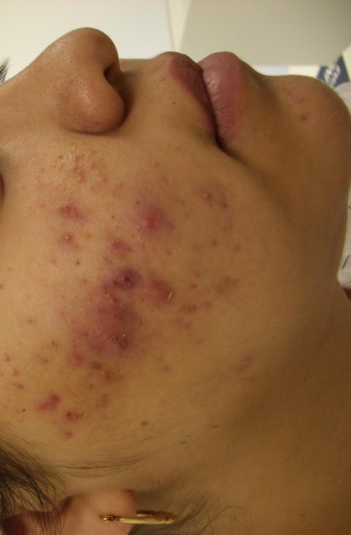 Acne affects 61% of patients with PCOS 40% in high-risk population Sites: Face Trunk No systemic associations No significant