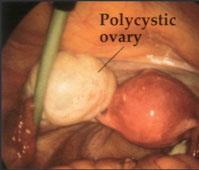 Laproscopic Ovarian Drilling (LOD)- Review results Surgical ovarian wedge resection was the first established treatment for anovulatory PCOS patients but was largely abandoned of the risk of
