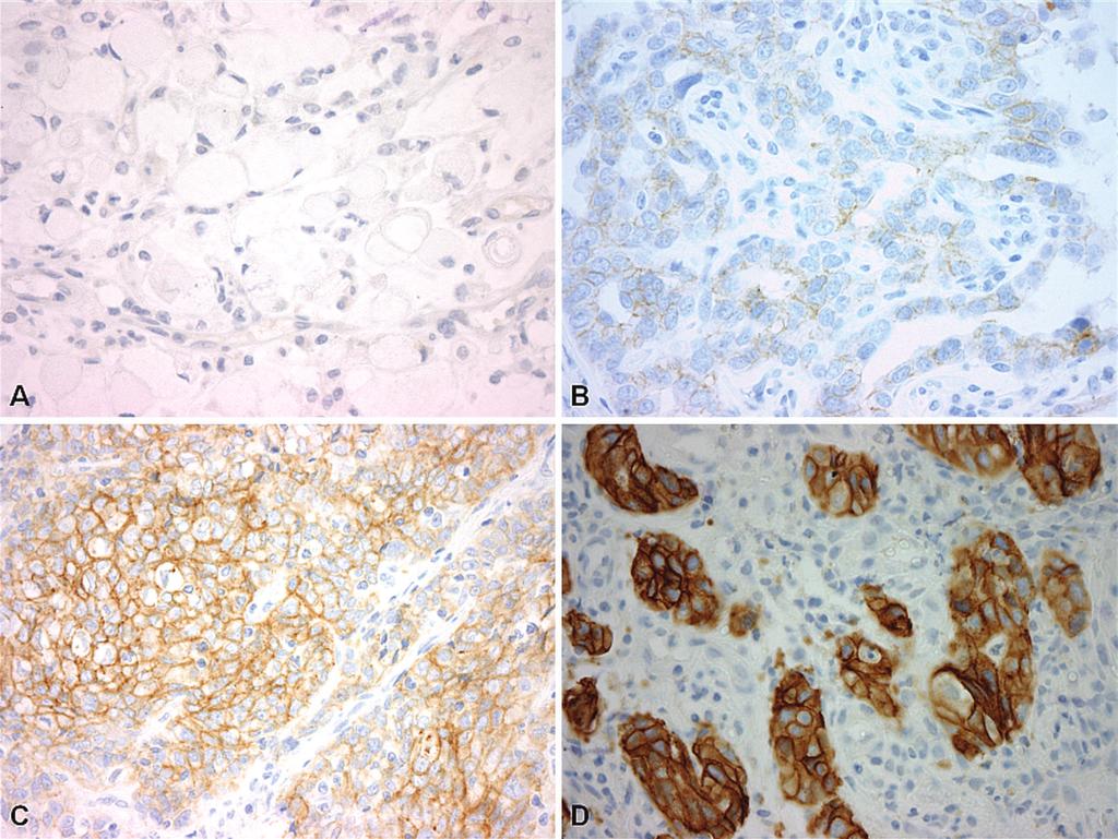 Figure 1. Examples of quantitative human epidermal growth factor receptor 2 (HER2/neu) immunohistochemistry (IHC) scoring in gastroesophageal specimens based on consensus guidelines.