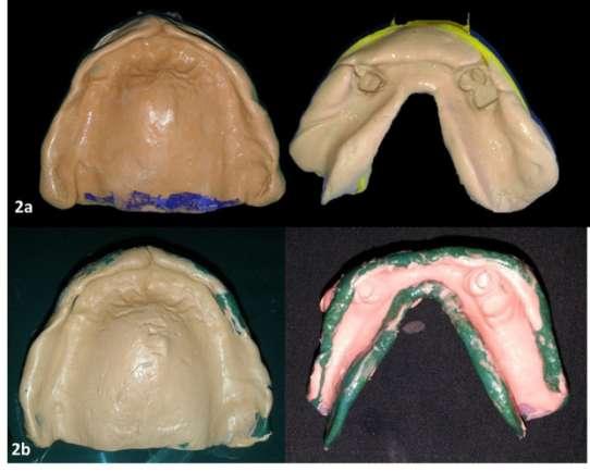 A diagnostic jaw relation was taken to analyzethe amount of space available for any attachment. The space was found to be sufficient for using magnetic attachments.