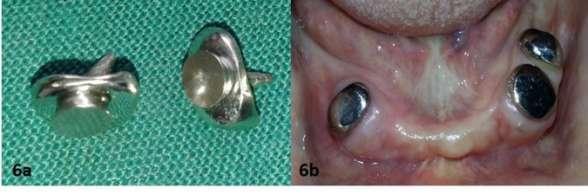 Fig-6a & 6b: Casted metal coping with magnetic keeper attachment. Fig-7: Positioning of the magnet on keeper in mouth for pick-up. Fig-8: Magnet incorporated in denture.