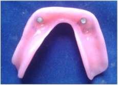 After taking a face bow record and mounting the rims on the articulator, teeth were arranged and try in was done after the approval of try in by the patient, the denture was processed using Heat cure
