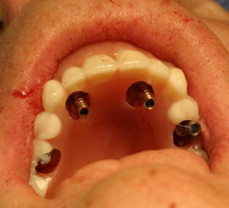 hollowed-out denture