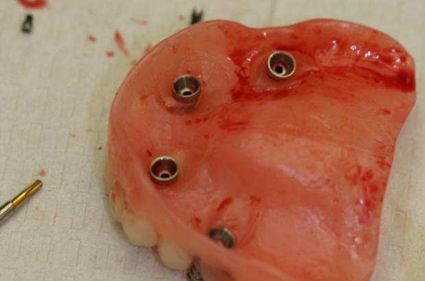 11. Remove Prosthesis with Temporary Coping Multi-unit cylinders