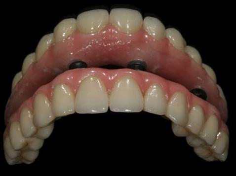 Polish and Smooth Surface of Fixed Implant Bridge Maintain intaglio