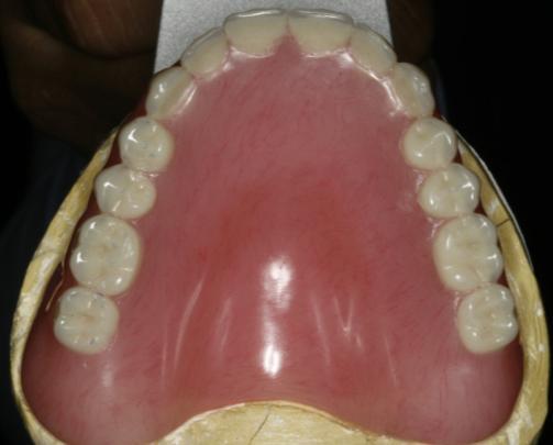 Dental Laboratory creates Immediate Denture & Surgical