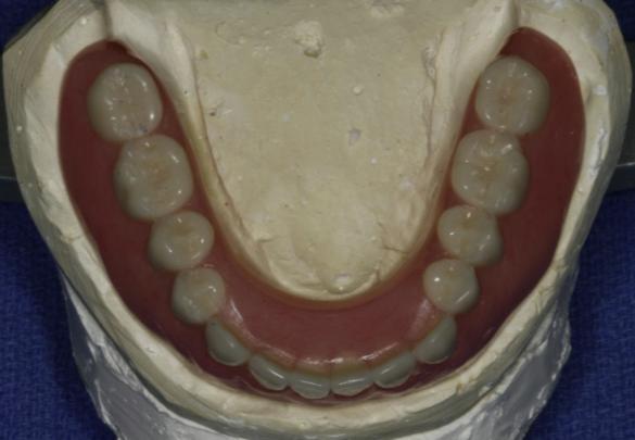 Wax Try-in Denture Based upon impression and bite