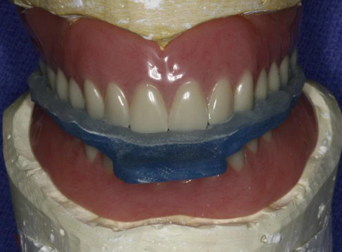 Improvements and modifications to the denture can be