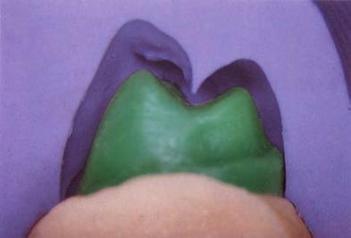 for metal-free aesthetic procedures Isolation of dentures in the flask Matrix for making temporary crowns/bridges Smooth surface Very high heat resistance (above 200 C) Excellent