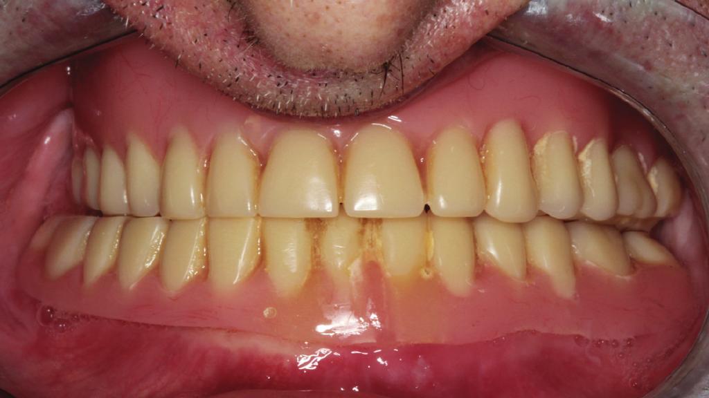 2 Case Reports in Dentistry (a) (b) (c) (d) Figure 1: (a) Old complete dentures. (b) Repetitive movement with Biotone artificial teeth. (c) Trial complete dentures with Biotone artificial teeth.