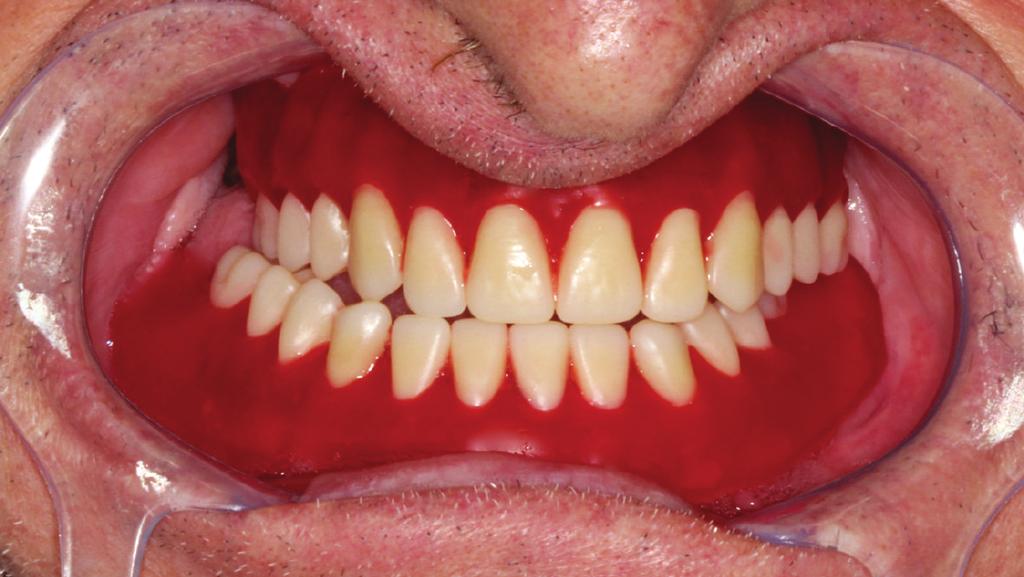 This clinical report displays how the application of different posterior teeth cusps heights can influence the excursive movements of the patient. 2.
