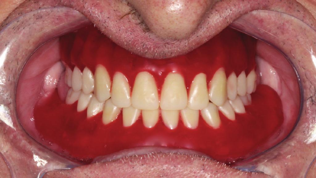 A 59-year-old man, complete denture wearer for over 10 years, presented severe occlusal wear in the premolar and molar areas, vertical dimension was reduced, and the denture bases were ill adapted.
