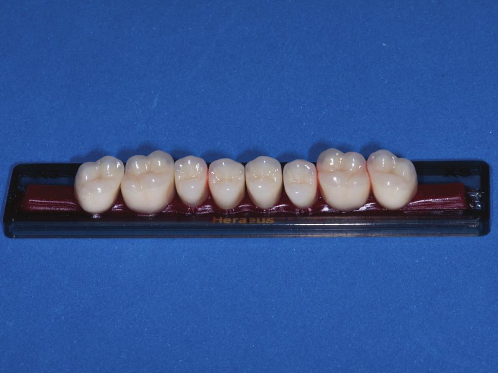 Case Reports in Dentistry 3 teeth. However, this condition was only achieved due to the correct horizontal maxillomandibular record and to an accurate occlusal adjustment.