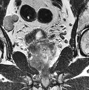 Prostate MRI: Pre operative planning Help select best candidates for surgical therapy. Assessment of neurovascular bundles prior to nerve sparing surgery.